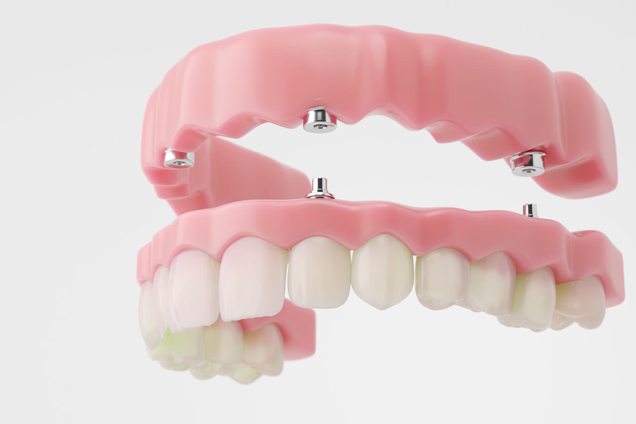 Looking for Snap-In Dentures in Palmdale? Discover Your Options