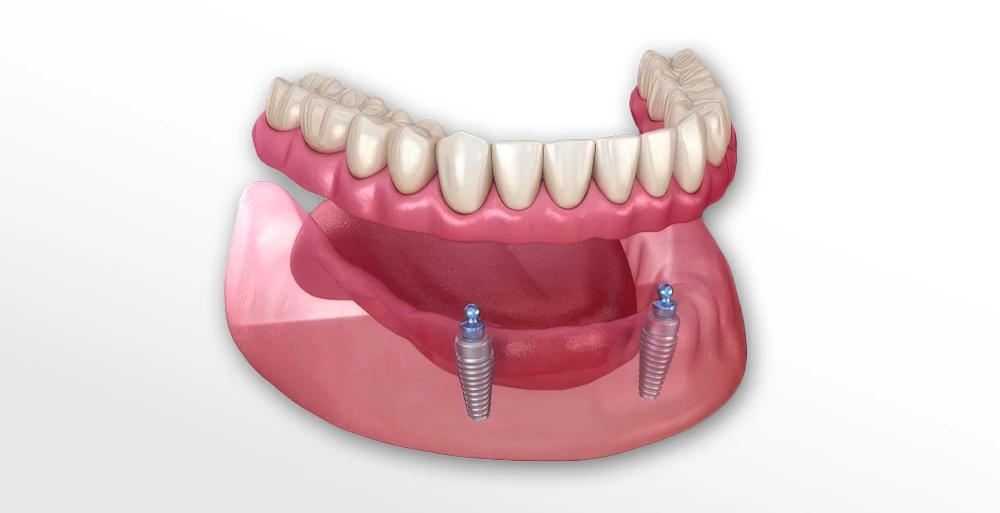 Snap-in dentures in Palmdale